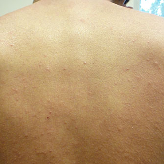 Photo of Allergic reaction from bed bug bites.