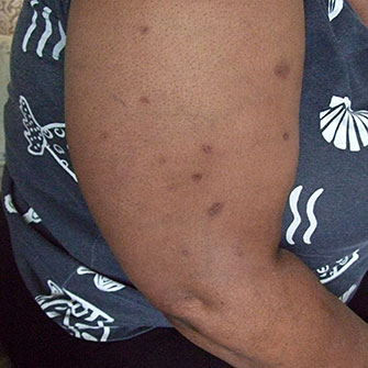 Photo of Arm, 8 months after being bitten.