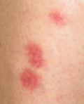 bed bug bites close up