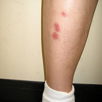 Photo of Bites on leg.