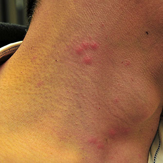 Photo of Bites on neck.
